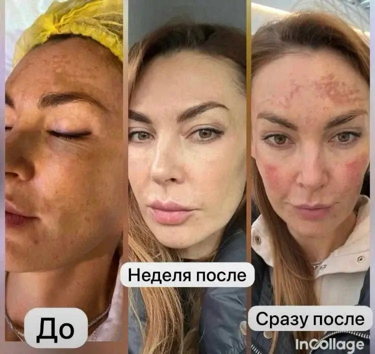 До процедуры