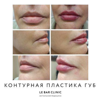 До процедуры